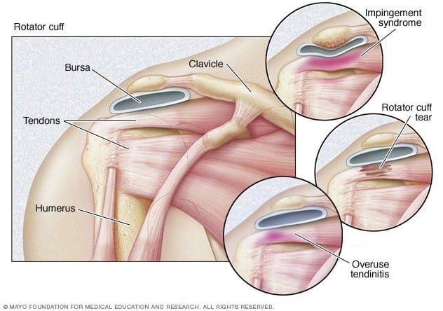 Rotator Cuff Tendinosis