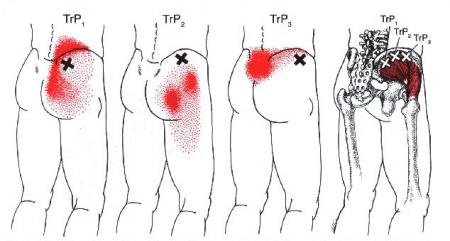 pain radiations