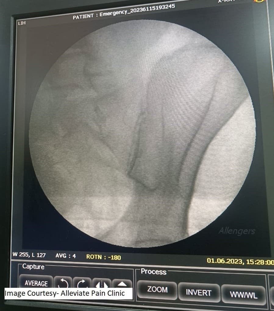 Scanning-PRP