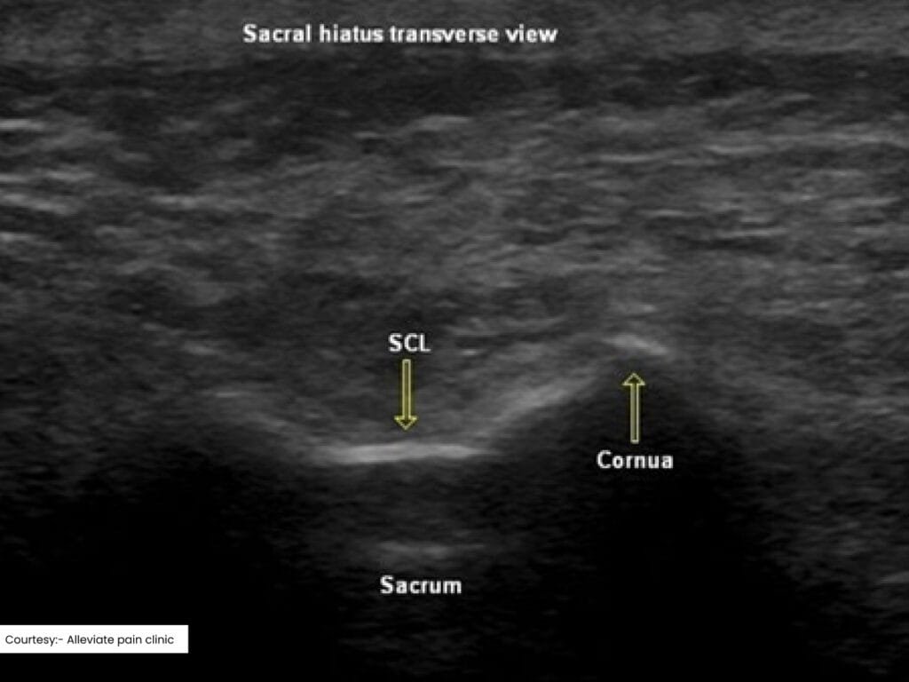 Caudal Epidural injection image 1